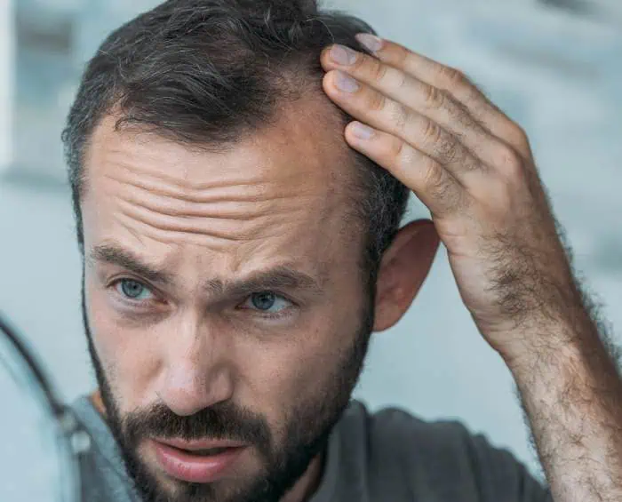 ALOPECIA HOME TEST