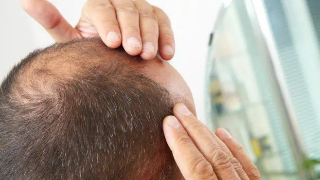Alopecia