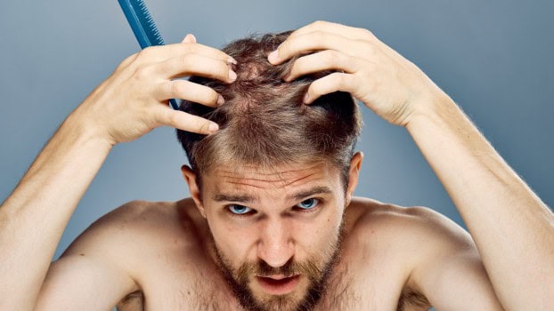 Alopecia: Come riconoscerla con un test del DNA