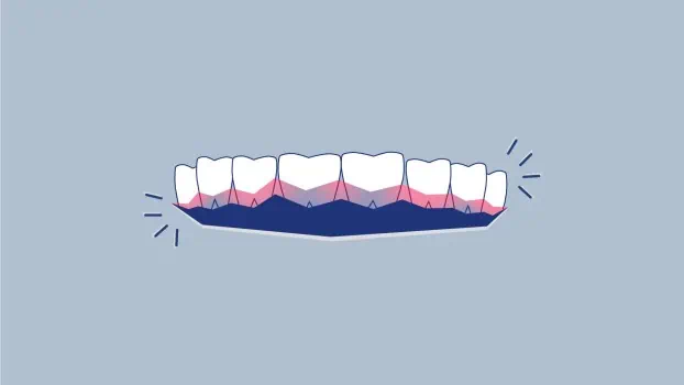 Paradontite, predisposizione con il test del DNA