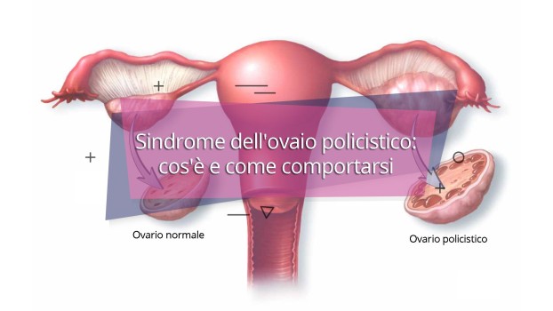 PCOS ( ovaio micropolicistico) cosa bisogna sapere