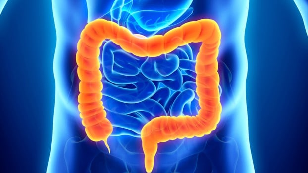 Il rischio genetico connesso al tumore del colon retto